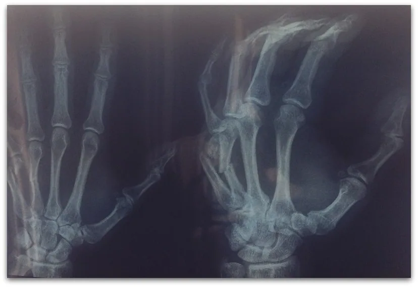 brokenhand