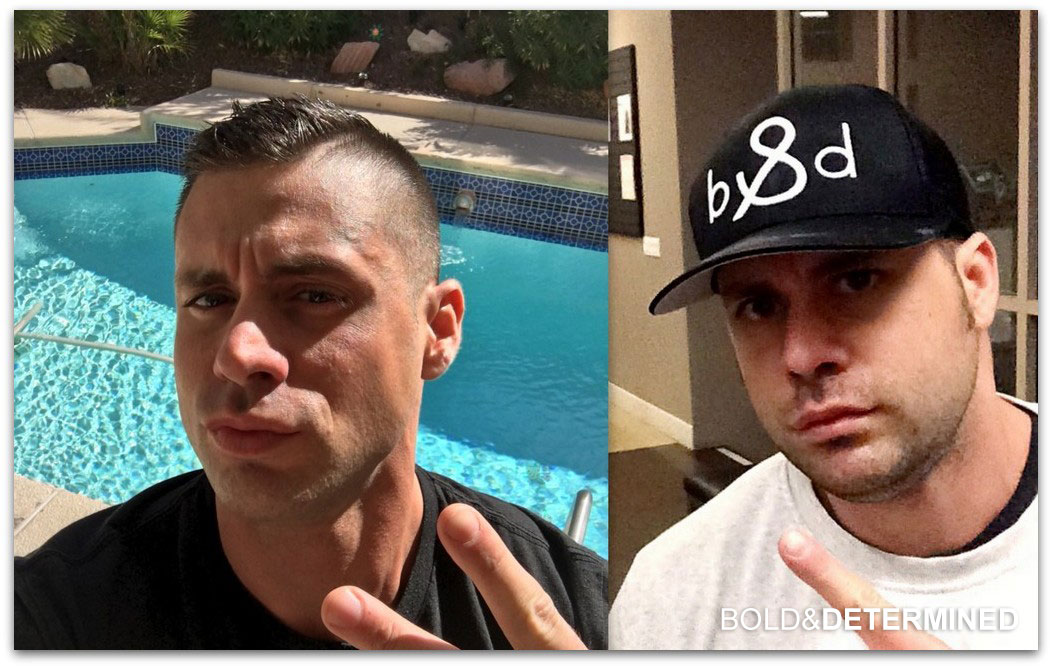 chiseled-jaw-vs-fat-bloated-face-before-and-after